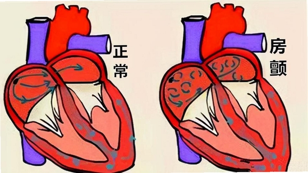 心房颤动 报错修复